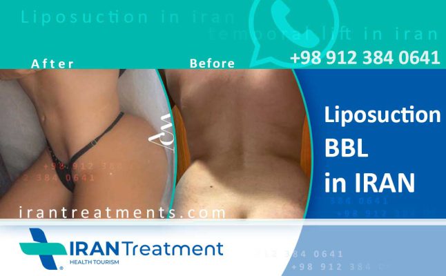 Liposuction in Iran - body contours