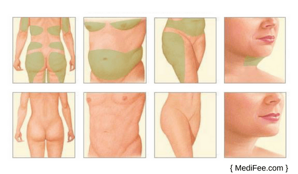 Body Contouring Surgery in Iran