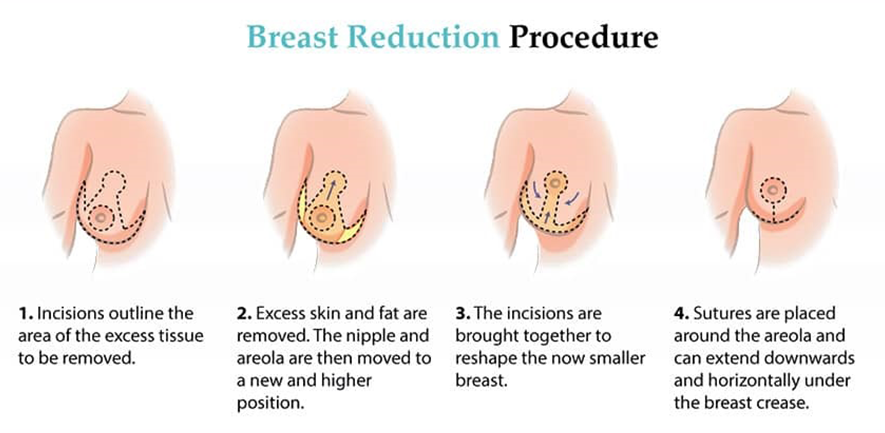 Breast Reduction in Iran - Reduction Mammoplasty - Price 2023 -  irantreatments - Plastic Surgery in Iran