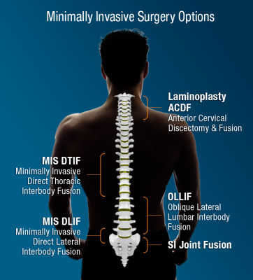 Spine Surgery in Iran