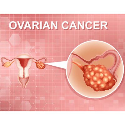 Ovarian cancer surgery in Iran