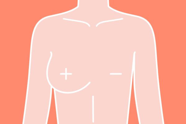 mastectomy in Iran