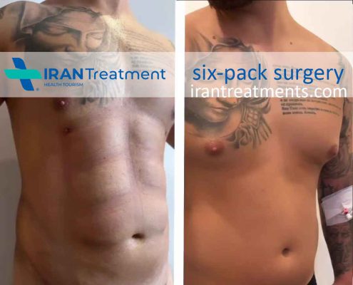 six-pack surgery in Iran - Abdominal etching