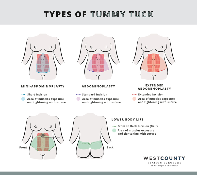 tummy tuck in Iran - Abdominoplasty type