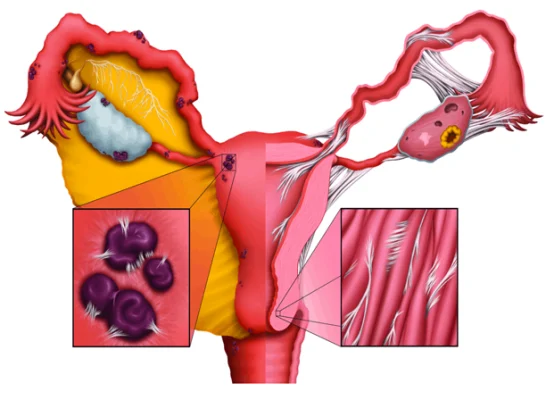 Endometriosis in Iran