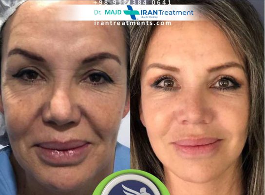 Dr. majd - facelift surgery in Iran