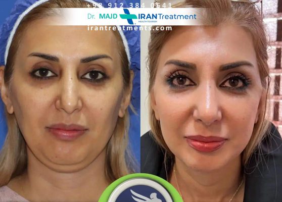 Dr. majd - facelift surgery in Iran