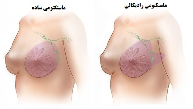 Mastectomy - breast removal surgery in Iran