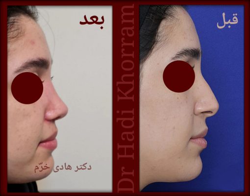Dr Hadi Khorram - Rhinoplasty ENT Surgeon in Iran