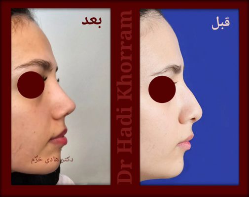 Dr Hadi Khorram - Rhinoplasty ENT Surgeon in Iran